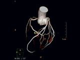 CT-Koronarangiographie